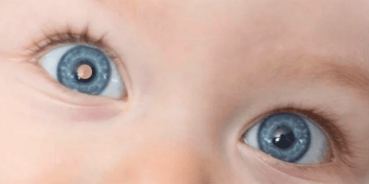 Retinoblastoma, um câncer raro que pode ocorrer nos olhos das crianças -  Blog Saúde Infantil